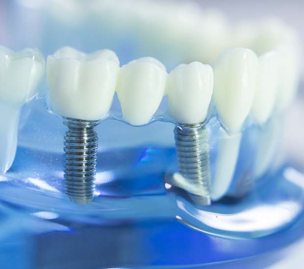 San Juan Capistrano Dental Implants