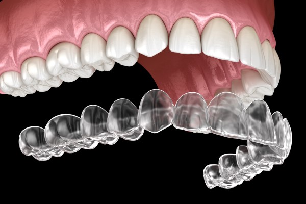 Don&#    ;t Worry About Damaging Invisalign® Aligners When Eating
