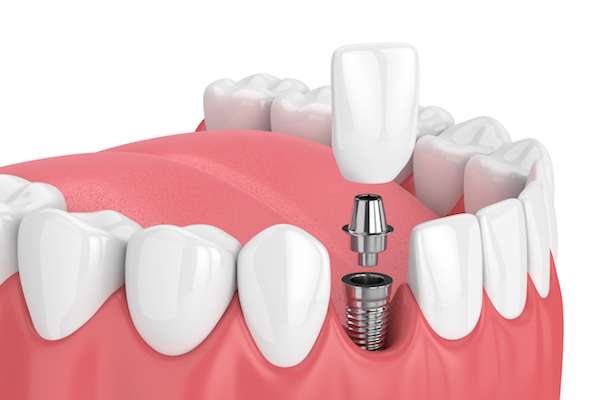 Mini vs. Regular Dental Implants from Ortega Dental Care in San Juan Capistrano, CA