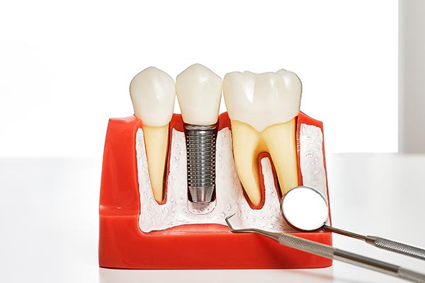 Your Guide to Different Kinds of Dental Implants from Ortega Dental Care in San Juan Capistrano, CA